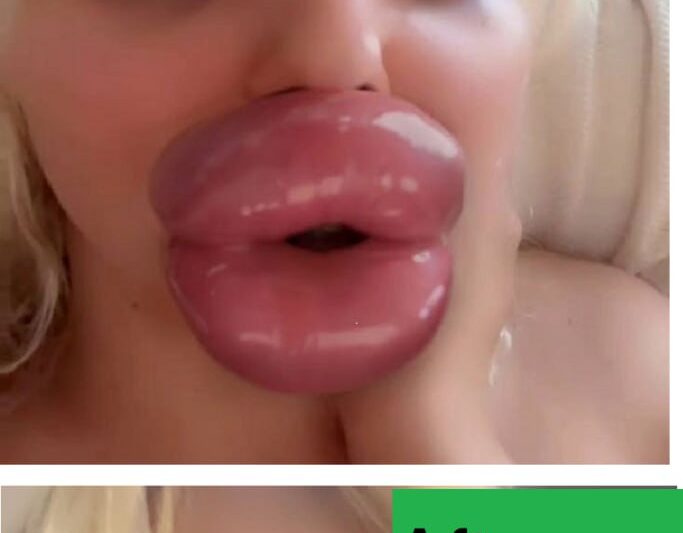 “I’m More Lips Than Human”, A Woman Struggles to Eat Due to Her Huge Lips but is Determined to Make Them Even Bigger